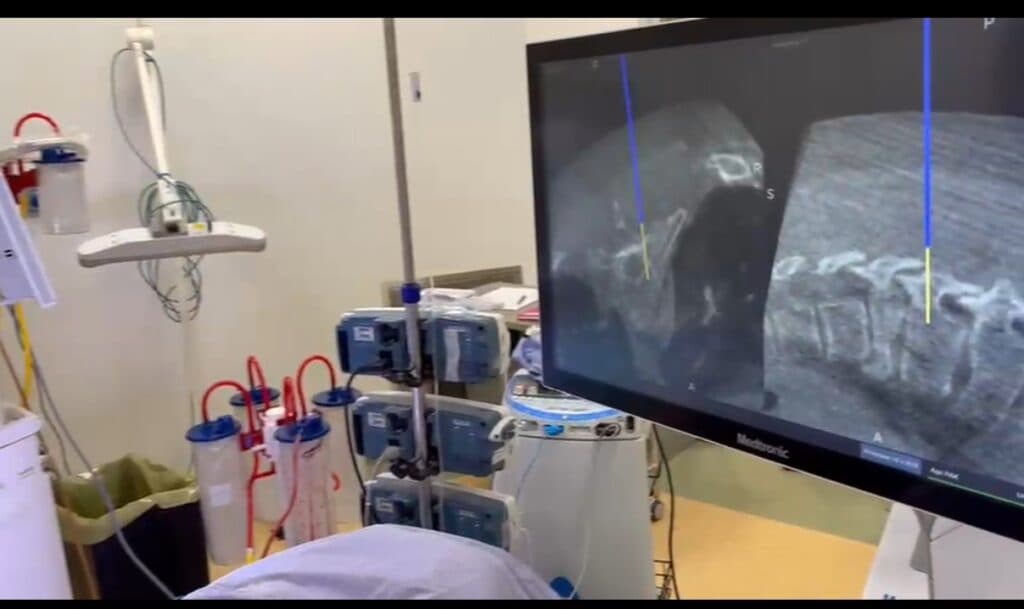 Navigazione spinale, ricostruito in 3D un tratto vertebrale ad un 15enne
